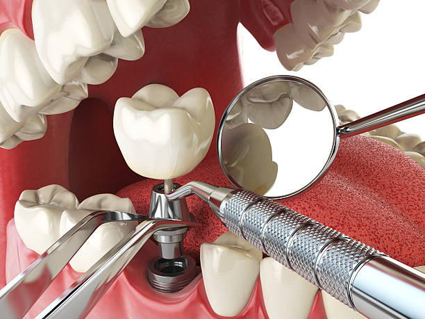 Best Emergency Wisdom Tooth Extraction in Paola, KS